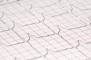 EKG diyagramı