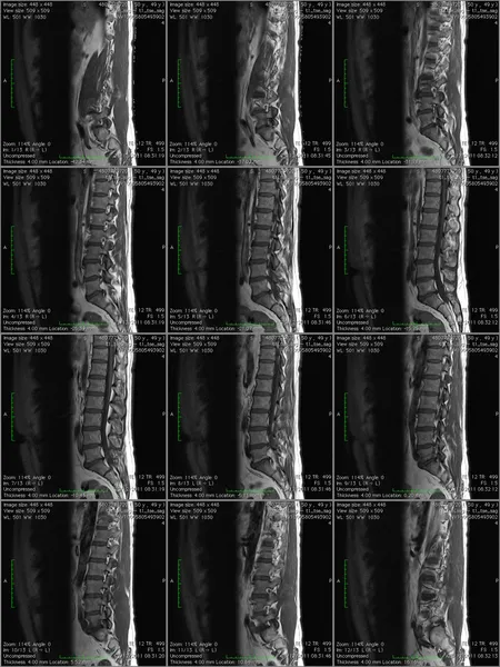 MRI Scan of Lower Back Region. Stock Photo