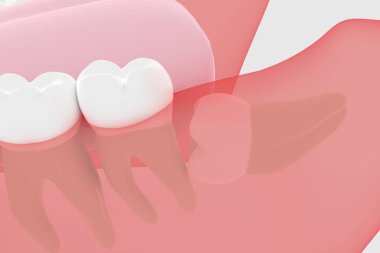Yirmilik diş 3D, diş etlerinde gömülü.