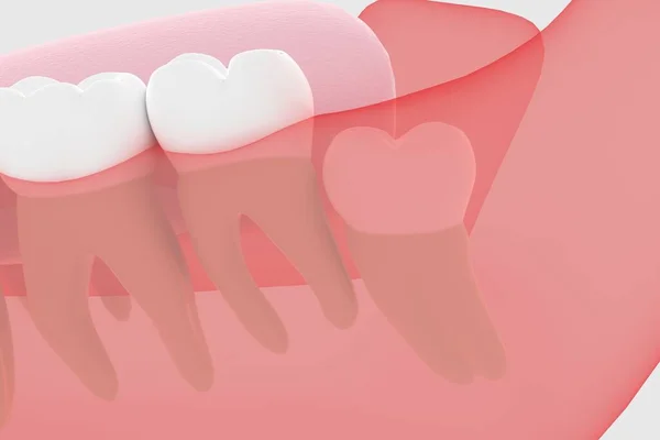 Wisdom tooth 3D rendering buried in the gums