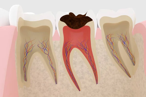 3D rendering of a cross section of a tooth with cavities