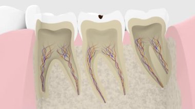 Caries ilerlemesinin bir kesitinin 3B canlandırması