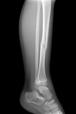 Kırık bacak röntgen görüntü plaka ve vida fiksasyonu tibia ve fibula kemiği gösterilen