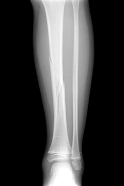 Kırık bacak röntgen görüntü sunan plaka - vida fiksasyonu tibia ve fibula kemiği
