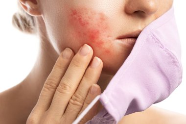Young woman with prevention mask and skin irritation on white background. Maskne - acne breakouts from wearing a face mask. clipart