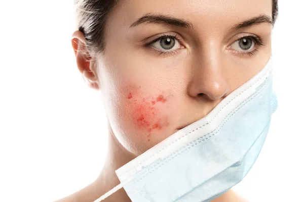 Young Woman Prevention Mask Skin Irritation White Background Maskne Acne — Stock Photo, Image