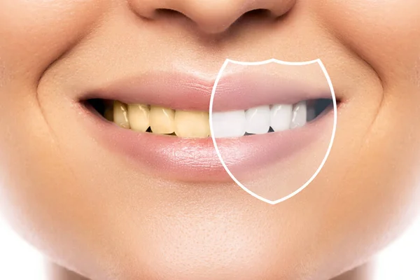 Piękny Uśmiech Kobiety Wybielanie Zębów Higiena Wynik Leczeniu Profesjonalnej Klinice — Zdjęcie stockowe