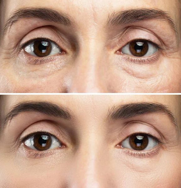 Traitement Âge Comparaison Des Yeux Féminins Avant Après Rajeunissement — Photo