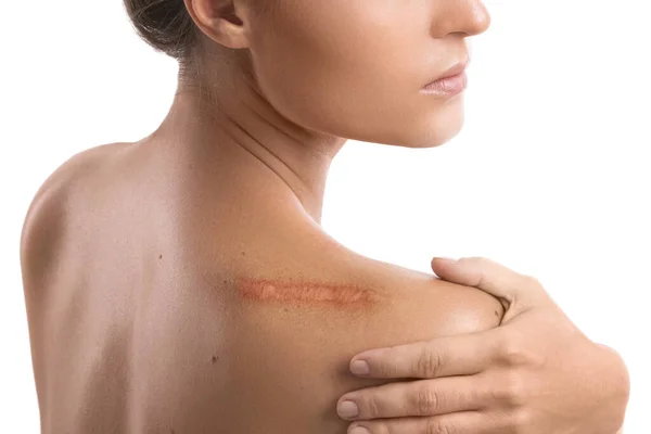 Woman Scar Her Shoulder White Background — Stock Photo, Image