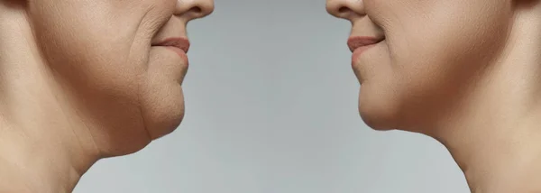 Perbedaan Setelah Operasi Plastik Double Chin Removal Facelift Neck Liposuction — Stok Foto
