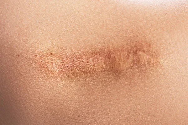 Fechar Ombro Feminino Com Uma Cicatriz Após Cirurgia — Fotografia de Stock