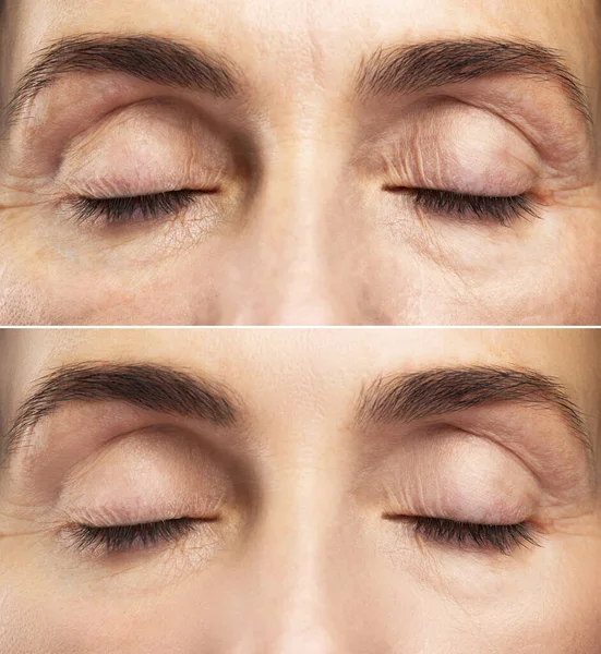 Yaşlanma Karşıtı Tedavi Yenilenmeden Önce Sonra Kadın Gözlerinin Karşılaştırılması — Stok fotoğraf