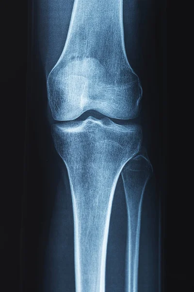 무릎의 엑스레이 이미지입니다 관절의 — 스톡 사진