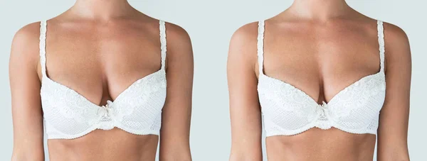Female Breast Comparison Breast Asymmetry Correction Surgery — Stock Photo, Image