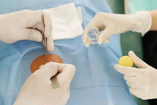 Médico Enfermeiro Durante Remoção Marca Nascença Cirurgia Dermatológica Clínica Médica — Fotografia de Stock