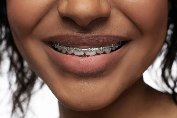 Концепция Ортодонтии Крупный План Улыбки Черной Женщины Зубными Скобками Зубах — стоковое фото
