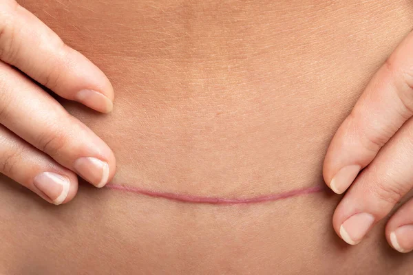 Primer Plano Cicatriz Después Cirugía Cesárea Vientre Femenino — Foto de Stock