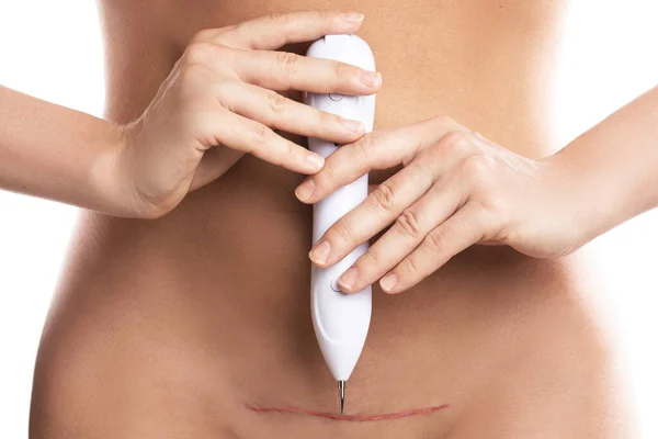 Mujer Con Una Cicatriz Después Cirugía Cesárea Está Utilizando Pluma — Foto de Stock