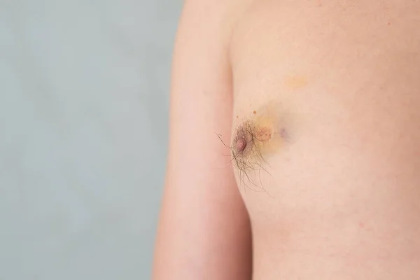 Male Nipple Injured Bruise Hematoma Close Disease Medicine Dermatology Treatment — Stock Photo, Image
