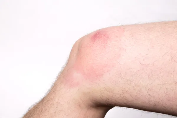 Swollen knee because of a wasp sting — Stock Photo, Image