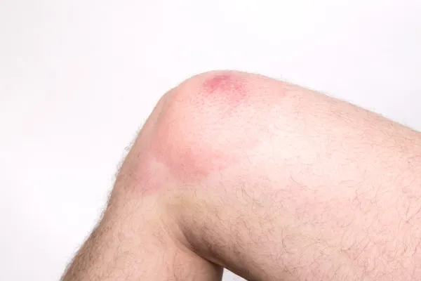 Geschwollenes Knie wegen Wespenstichs Stockbild