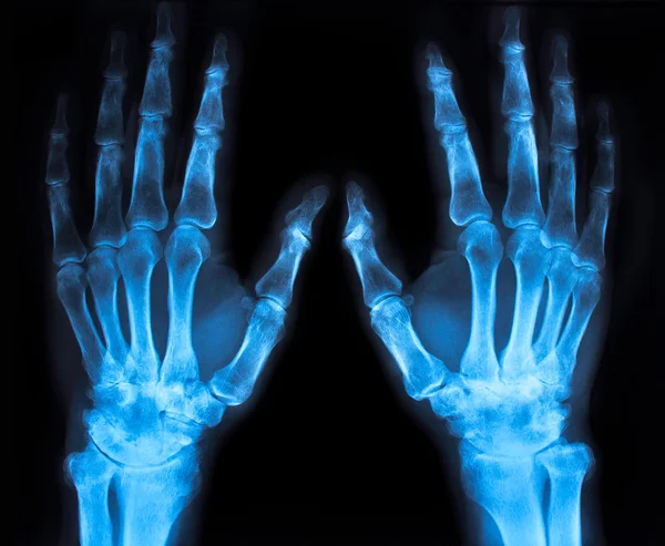 Röntgenfoto van een hand (blauw) — Stockfoto
