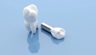 diş implantı ve diş