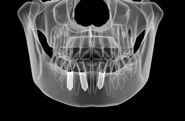 Fogászati implantátum és fogak — Stock Fotó