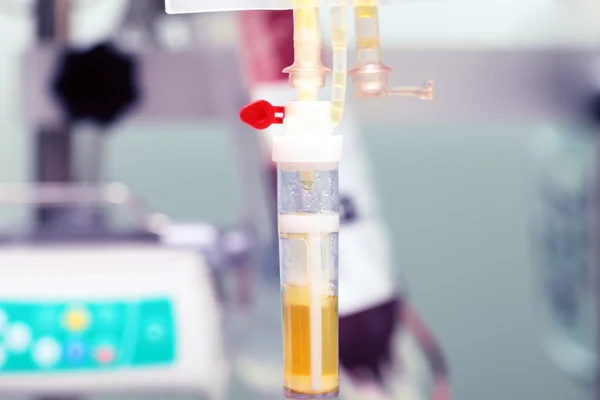 Transfusie van menselijk plasma in ziekenhuis — Stockfoto
