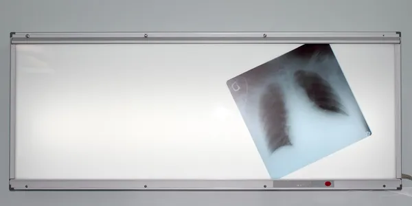 X-ray of the lungs on negatoscope — Stock Photo, Image