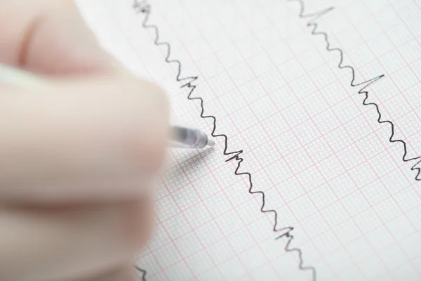 Analysering av EKG. hand med en penna på EKG. — Stockfoto