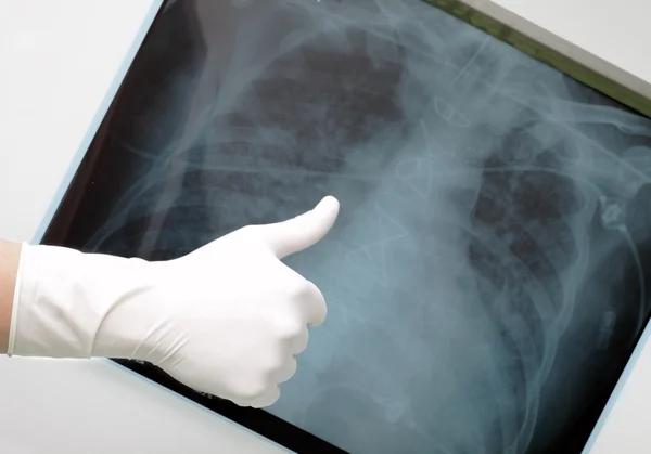 Mano con pulgar hacia arriba en el fondo de una radiografía de los pulmones . — Foto de Stock