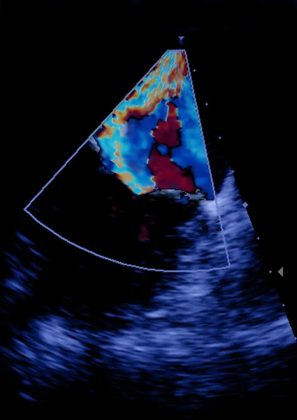 Tela da máquina de ecocardiografia (ultra-som). Total mitral em — Fotografia de Stock