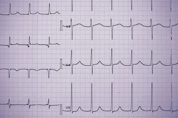 EKG zdravý člověk. profesní informace. — Stock fotografie