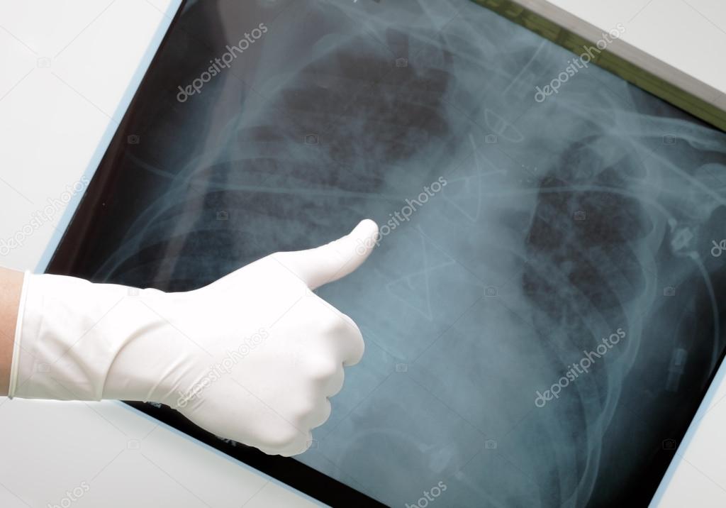 Hand with thumb up on the background of an X-ray of the lungs.