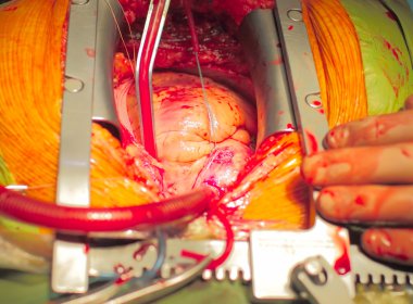 cardiosurgical işlemleri