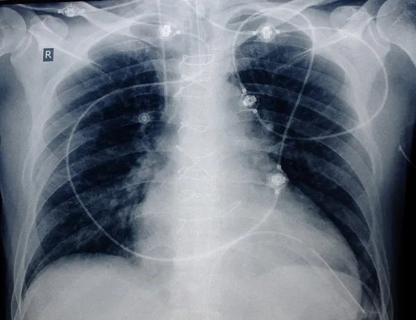 Röntgenogramm der Brust des Patienten nach einer Herzoperation — Stockfoto