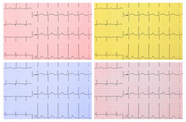 tıbbi geçmişi. EKG. tonlama ve 4 tip.