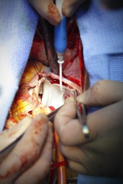 ağız içi boş damarlar, plastik mitral kapak ablasyon