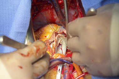 Cardiac surgery clipart