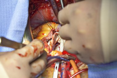 Açık kalp ameliyatı. mitral kapak plastik.