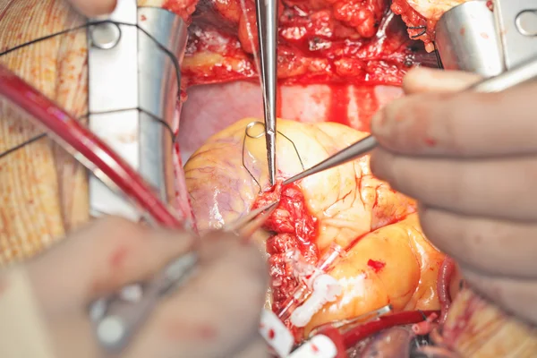 Coronary surgery. Close-up photo. photo for professionals. — Stock Photo, Image