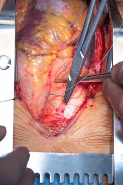 kalp cerrahisi. aorta üzerinde çalışıyorum. belgesel fotoğraf