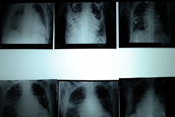 Radiographie pulmonaire. pathologie variée du cœur et des poumons — Photo