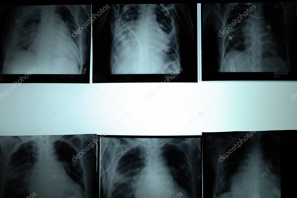 chest x-ray. various types pathology of the heart and lung