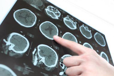 CT scan of the patient's brain and the hand of a doctor. clipart