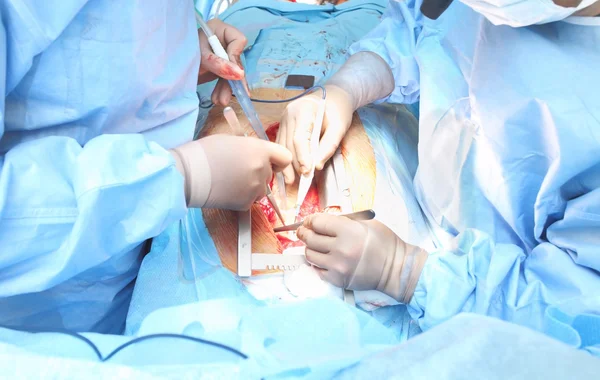 Cirugía cardíaca. Cirugía a corazón abierto . — Foto de Stock