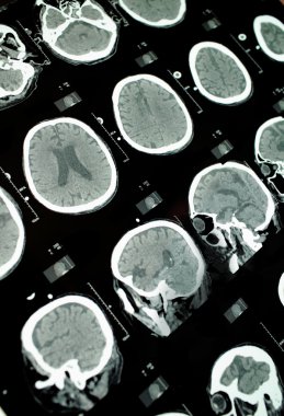 beyin BT görüntüsü