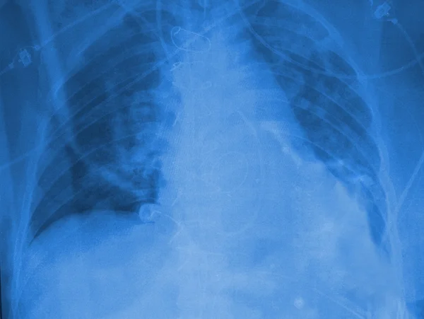 Рентген грудной клетки. Синий тонинг . — стоковое фото