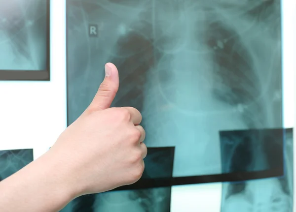 Thumb up on the background of the X-ray images — Stock Photo, Image